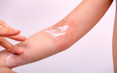 Eczema y piel reactiva: el silicio orgánico como complemento natural